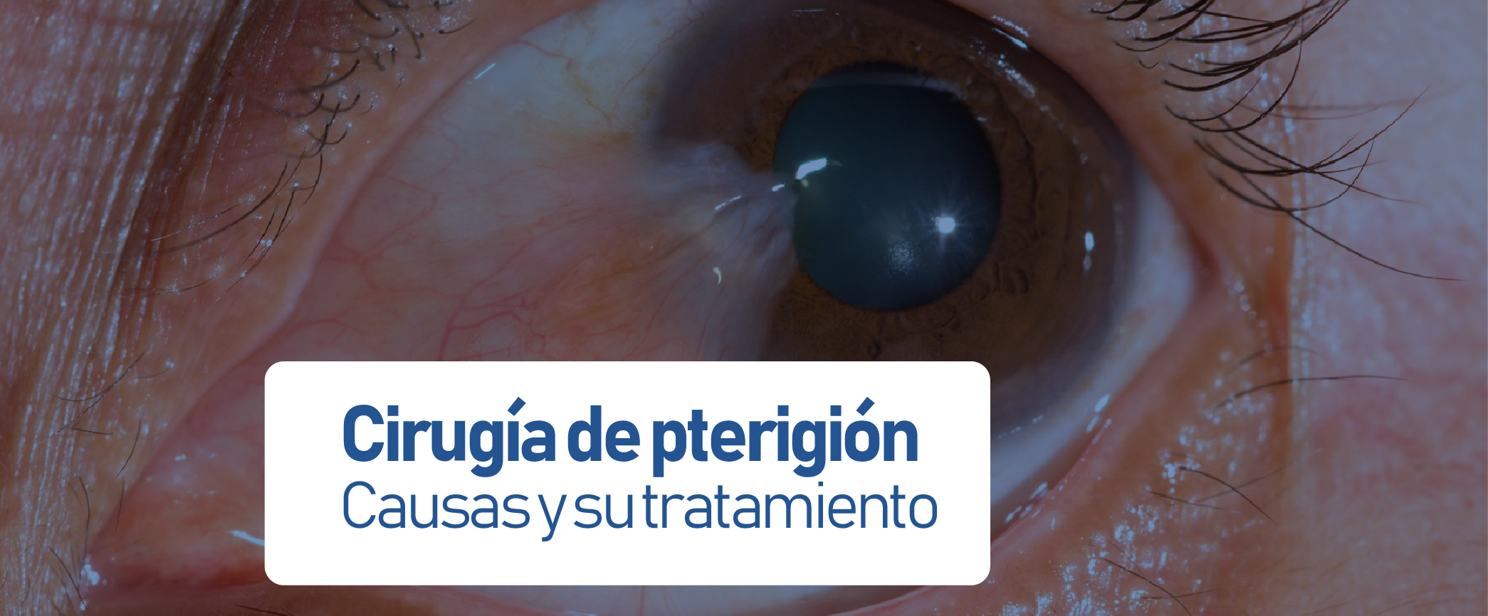 Cirugía de pterigión