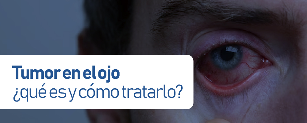 Tumor en el ojo ¿qué es y cómo tratarlo?