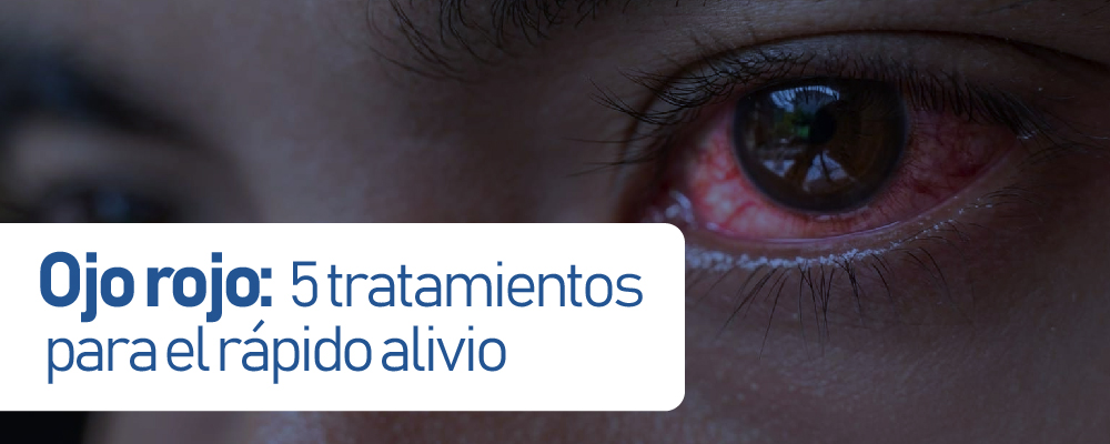Ojo rojo: 5 tratamientos para el alivio rápido