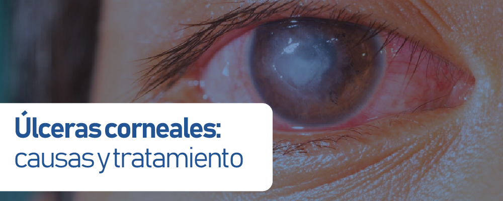Úlceras corneales: causas y tratamiento