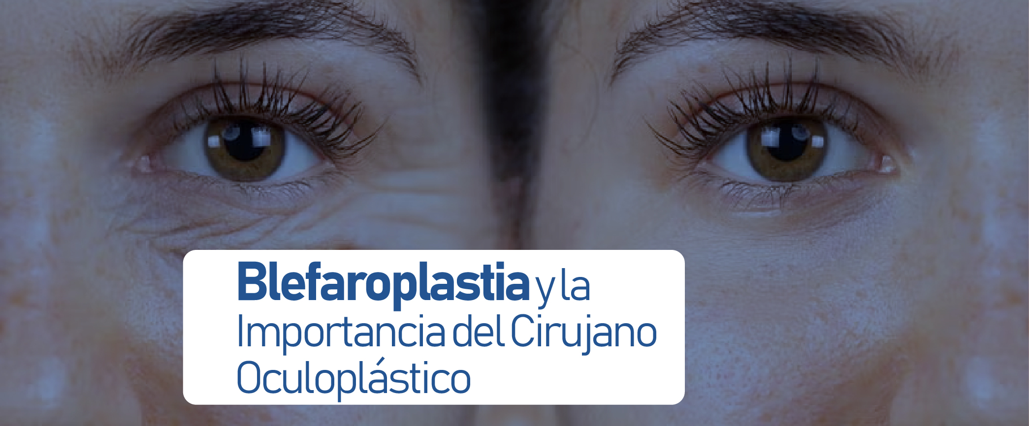 Blefaroplastia y la Importancia del Cirujano Oculoplástico