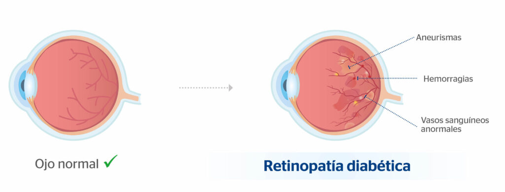  [ojo normal vs ojo con retinopatía diabética]